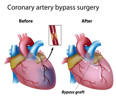 Heart Bypass Surgery by OrangeCountySurgeons